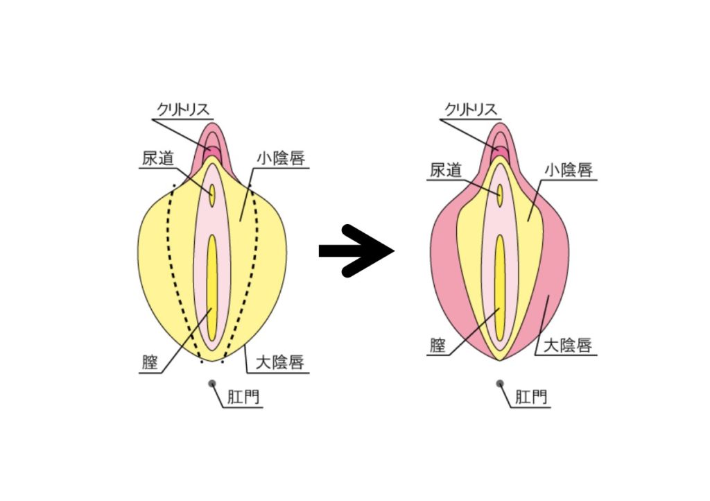 外陰部の美容形成手術（ﾚｰｻﾞｰﾃﾞｻﾞｲﾆﾝｸﾞ） 女性医療クリニックLUNA